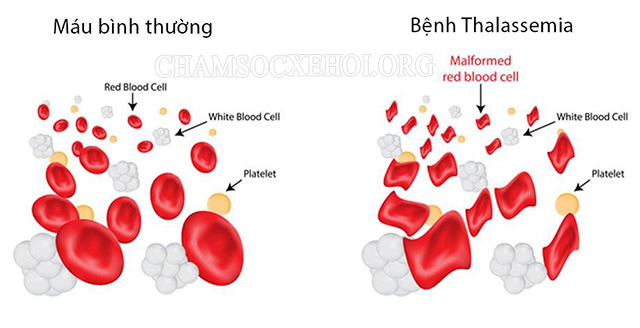 Đột biến gen trong cấu trúc chuỗi globin là nguyên nhân gây bệnh Thalassemia 