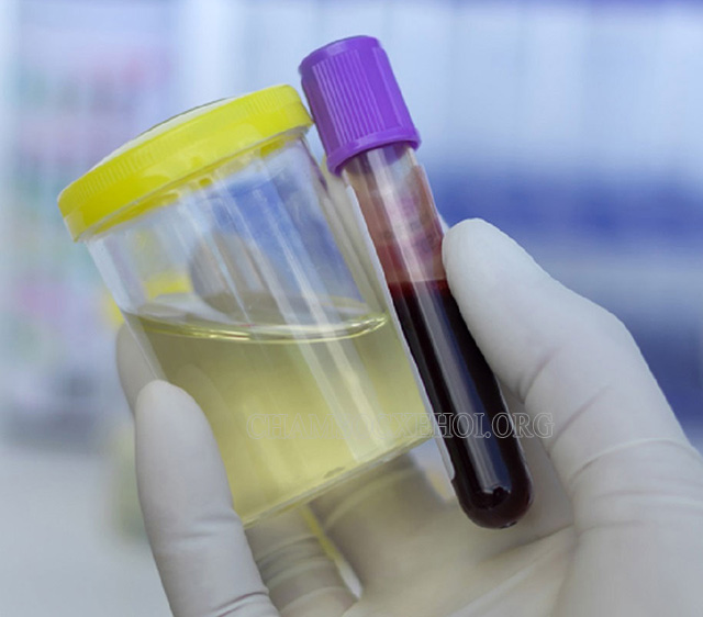 Kiểm tra mẫu máu và mẫu nước tiểu – Cách kiểm tra doping hiện nay